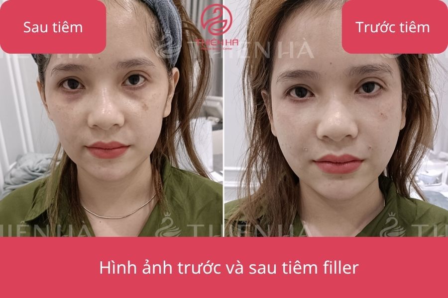 Hình ảnh trước và sau khi tiêm filler