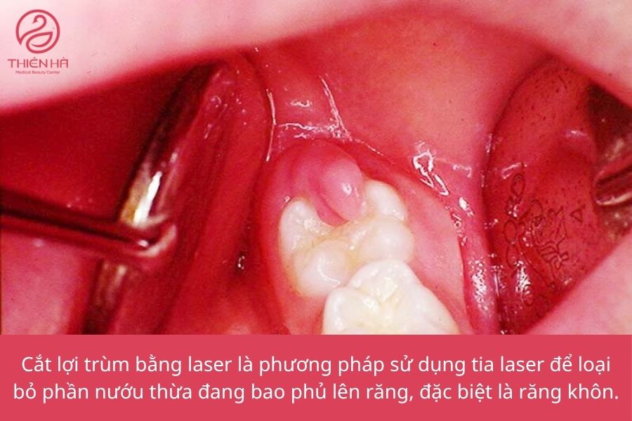 Cắt lợi trùm bằng laser là gì 