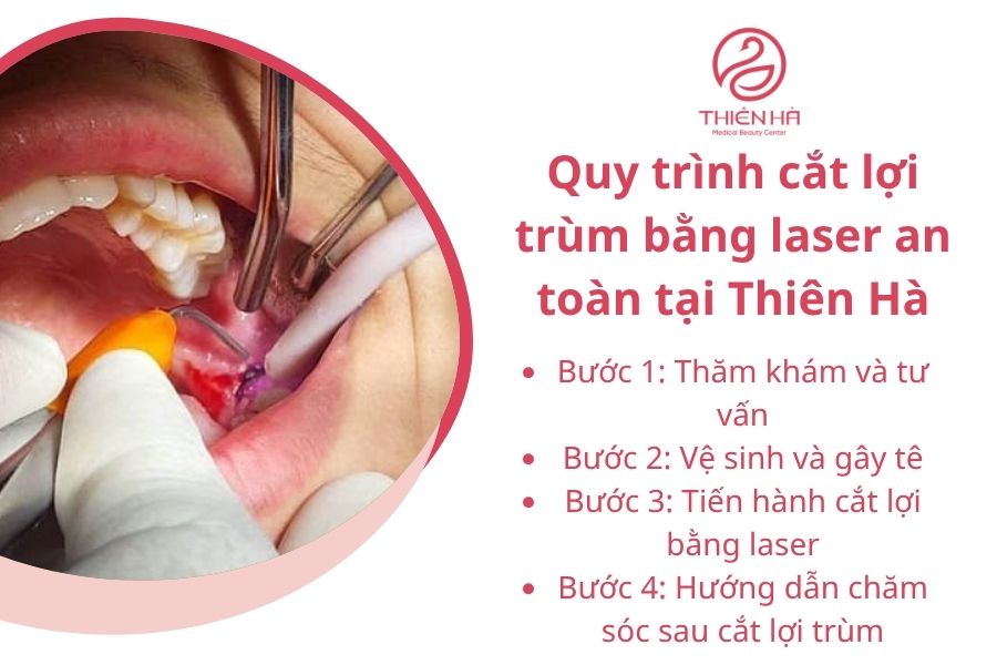 Quy trình cắt lợi trùm bằng laser an toàn và hiệu quả tại Viện thẩm mỹ Thiên Hà