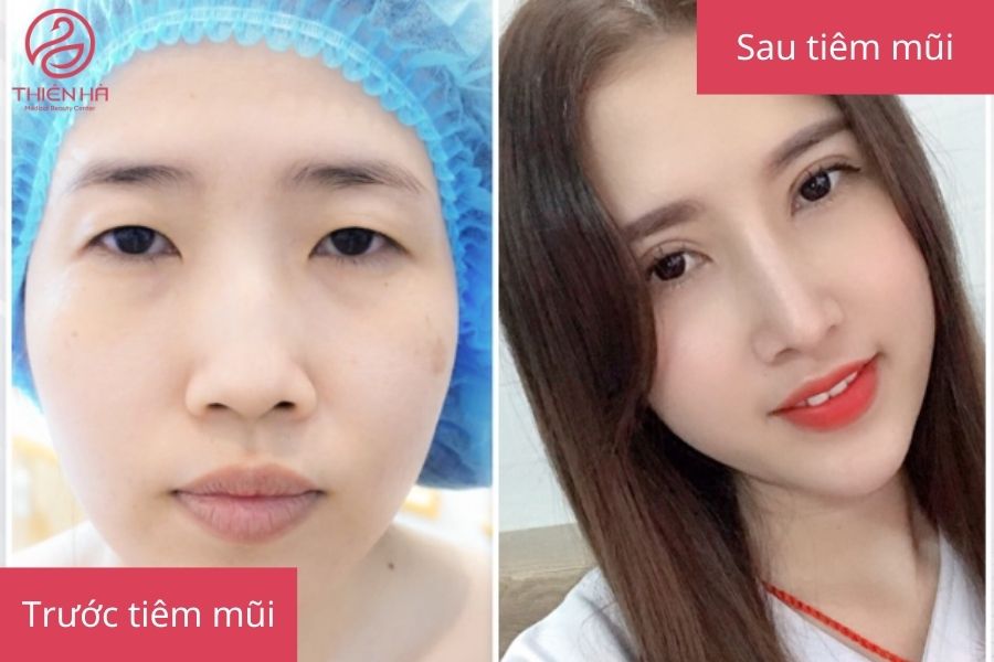 Kết quả trước và sau khi tiêm filler mũi