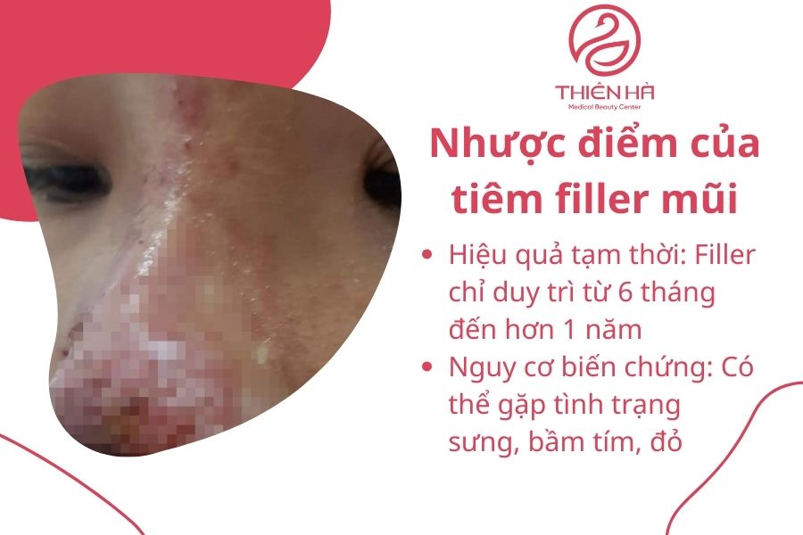 Biến chứng tiêm filler mũi cần lưu ý