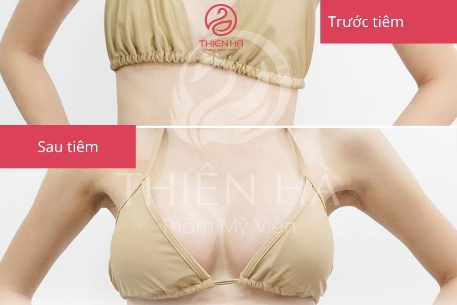 Kết quả trước và sau khi tiêm filler body