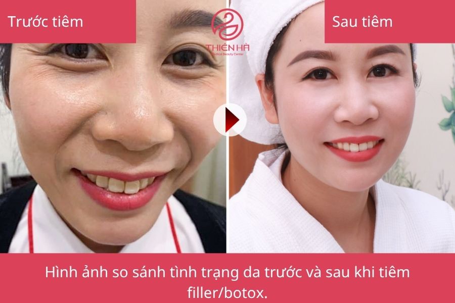 Kết quả trước và sau khi tiêm filler/botox