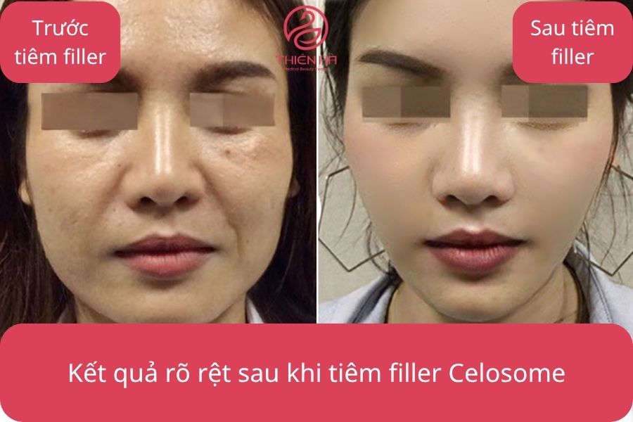 Kết quả thực tế sau khi tiêm filler Celosome