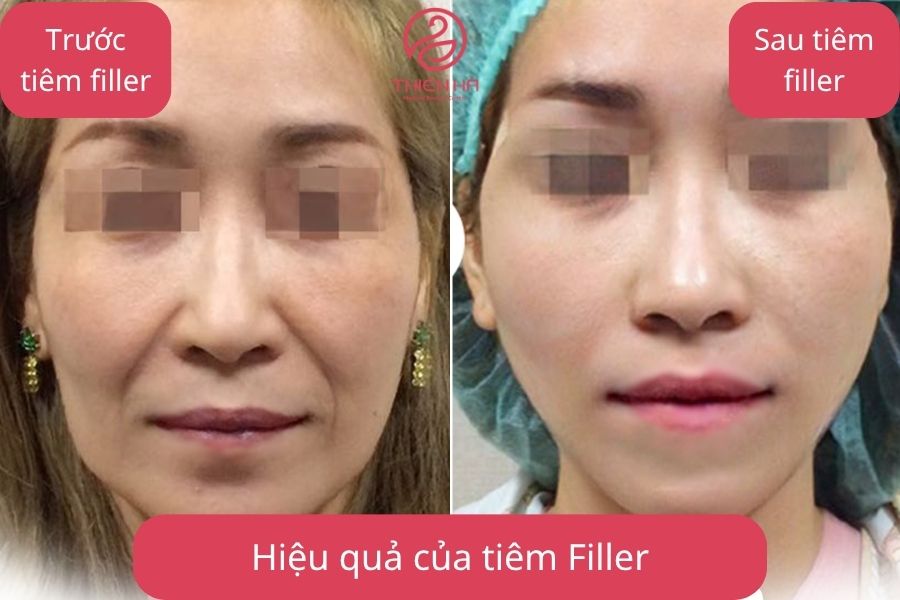 Hiệu quả của tiêm Filler