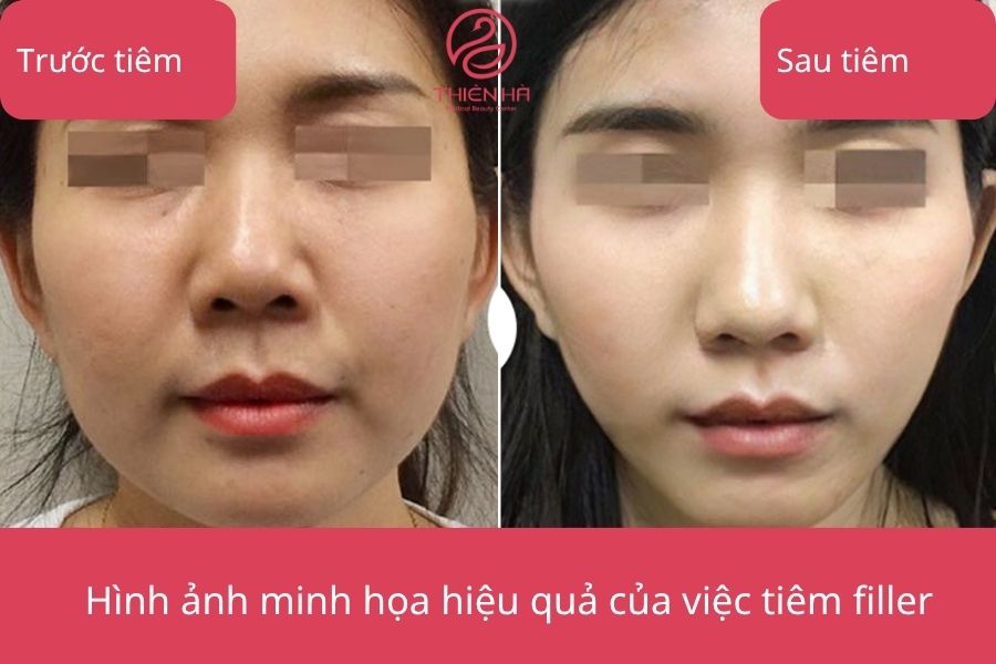 Trước và sau khi tiêm filler