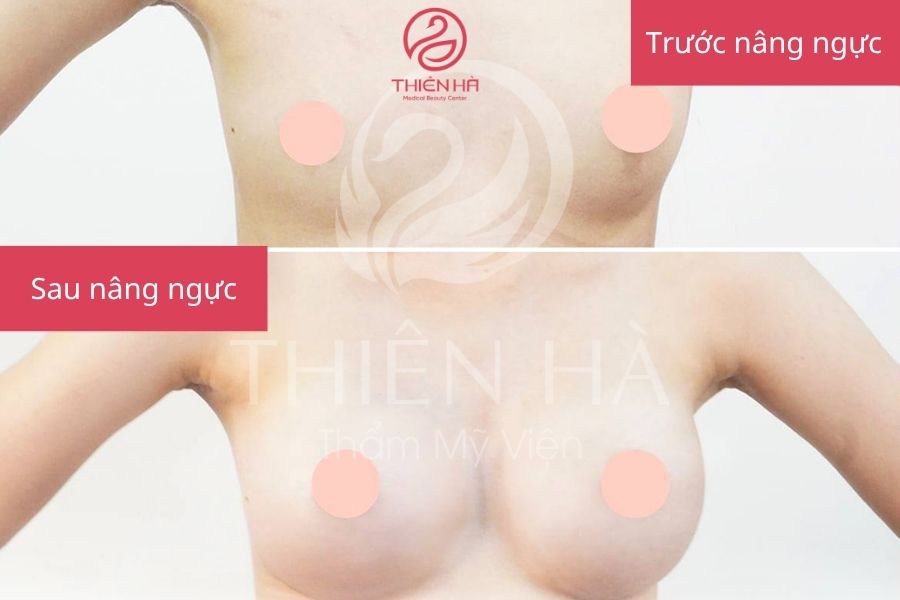 Kết quả nâng ngực bằng Filler