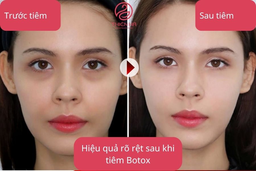 Hình ảnh so sánh cho thấy sự khác biệt trước và sau khi tiêm Botox