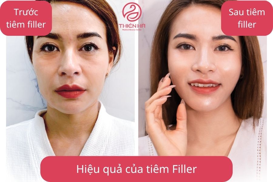  Trước & sau khi tiêm filler
