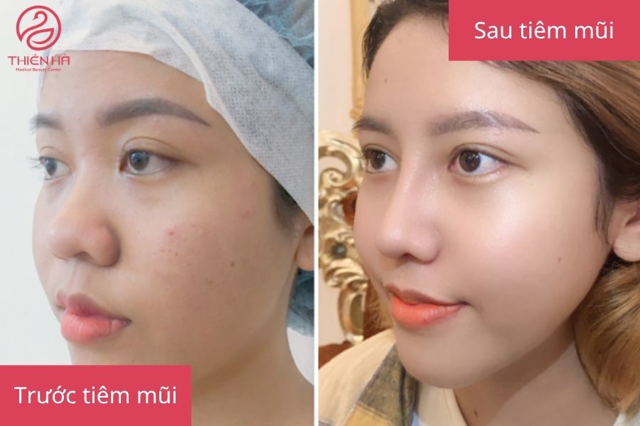 Kết quả trước và sau khi tiêm filler mũi