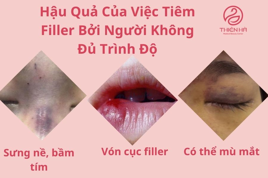 Biến chứng tiềm ẩn khi tiêm filler bởi người không đủ trình độ