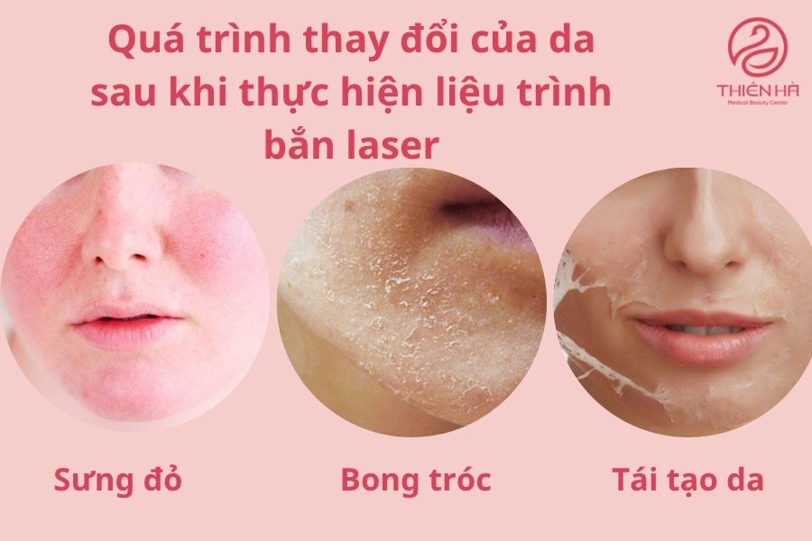 Các giai đoạn phục hồi da sau bắn laser