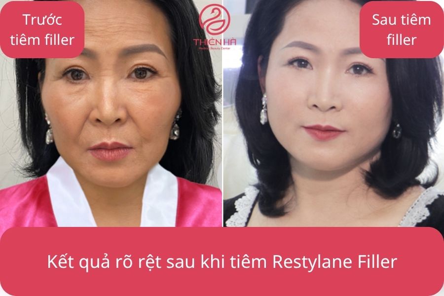Làn da trở nên căng mịn, trẻ trung hơn sau khi tiêm Restylane Filler