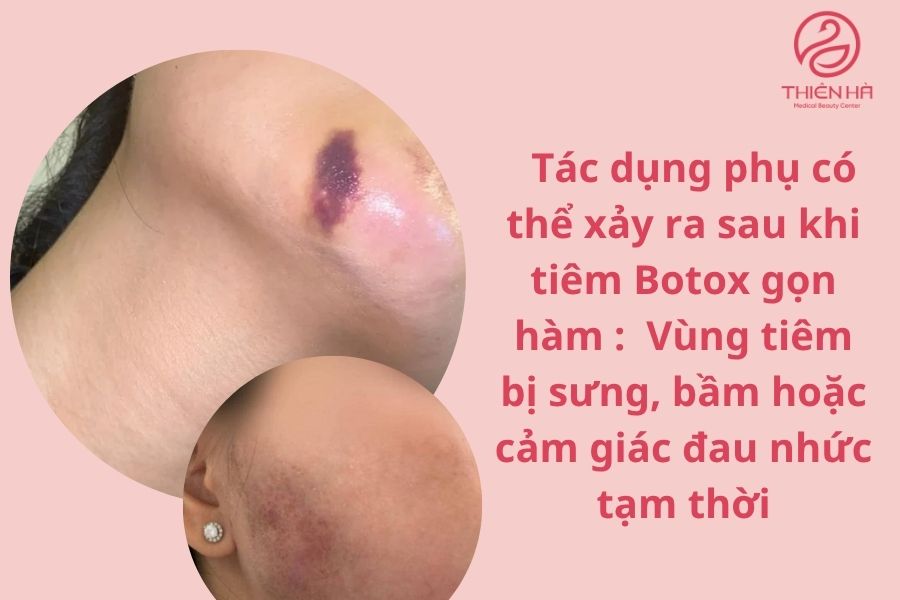 Tác dụng phụ của tiêm Botox gọn hàm