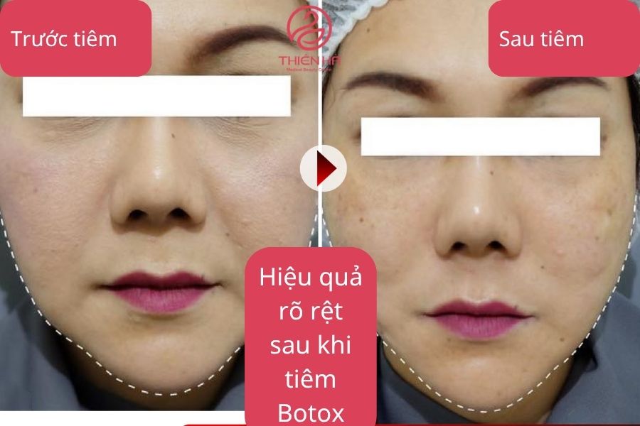 Hình ảnh minh họa sự thay đổi của khuôn mặt sau khi tiêm Botox gọn hàm