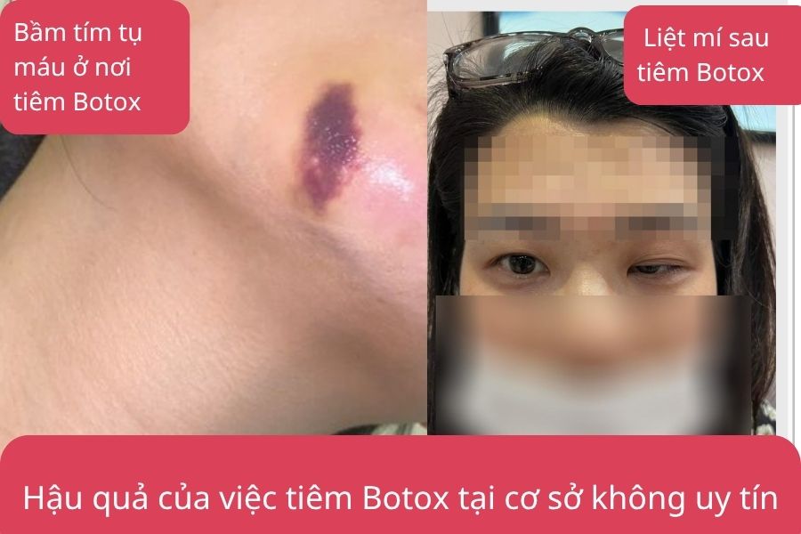 Rủi ro khi tiêm Botox tại cơ sở không uy tín