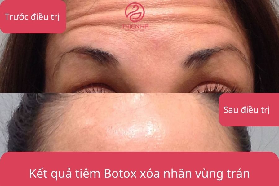 Hình ảnh thực tế sau tiêm Botox