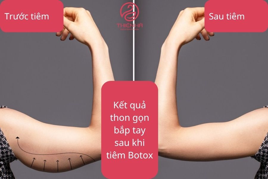 Sự khác biệt rõ rệt về kích thước bắp tay trước và sau khi tiêm Botox