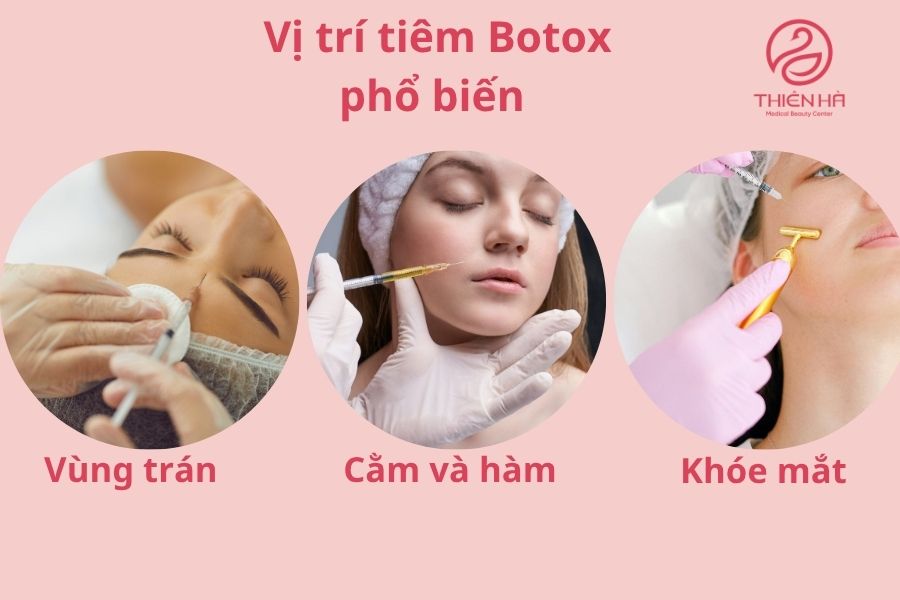 Các vị trí tiêm Botox phổ biến