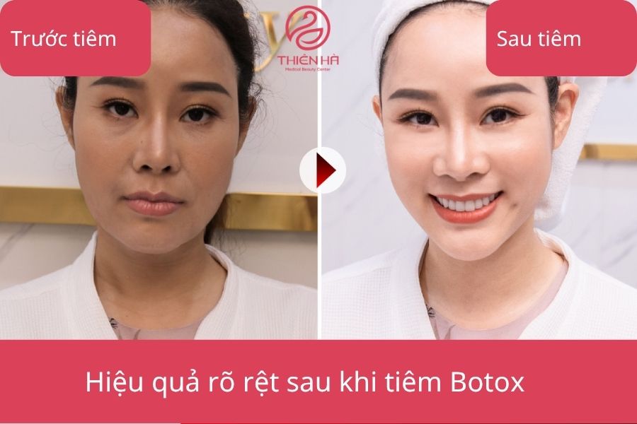 Hiệu quả của tiêm Botox