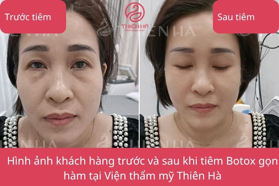 Hình ảnh khách hàng trước và sau khi tiêm Botox gọn hàm tại Viện Thẩm Mỹ Thiên Hà
