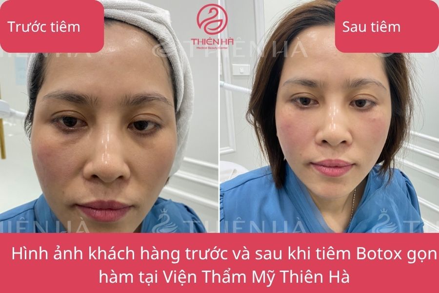 Kết quả tiêm Botox gọn hàm tại Viện thẩm mỹ Thiên Hà