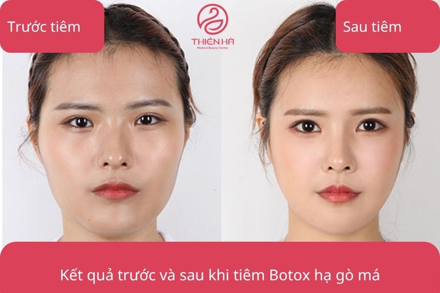 Hình ảnh so sánh rõ ràng sự thay đổi của khuôn mặt sau khi tiêm Botox