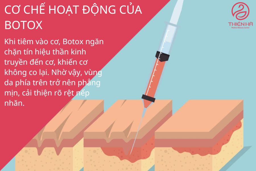 Botox ức chế sự co cơ, làm giảm nếp nhăn