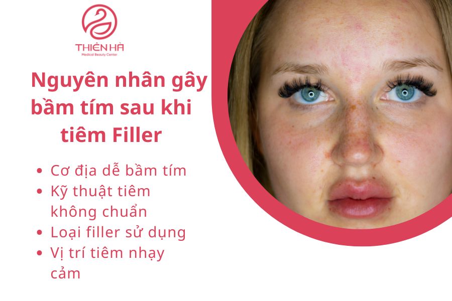 Nguyên nhân gây bầm tím sau khi tiêm Filler