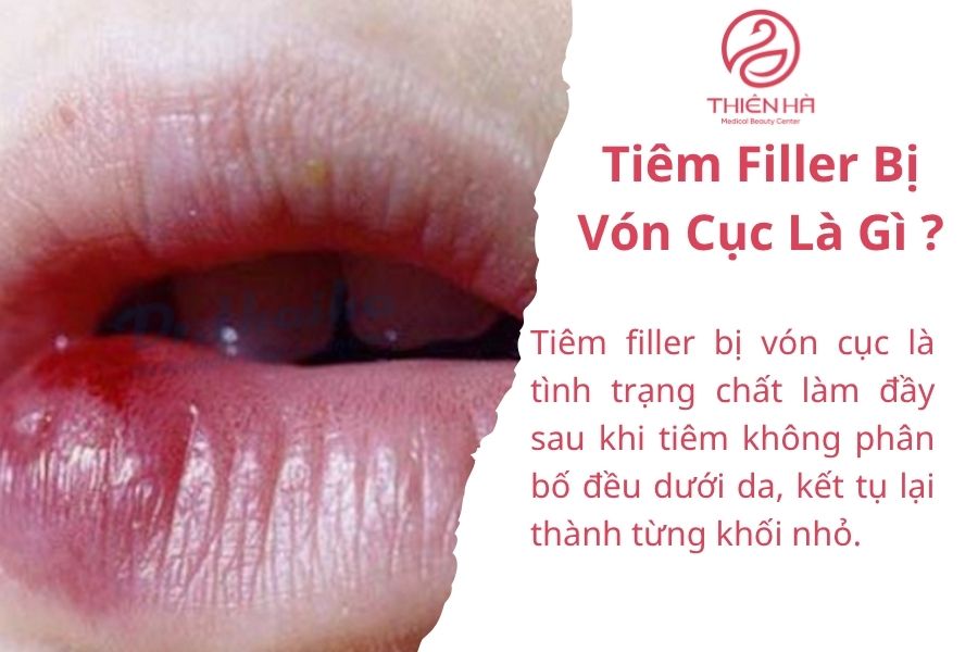 Tiêm Filler Bị Vón Cục Là Gì?