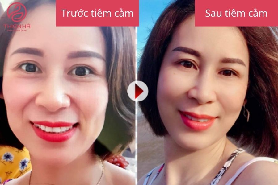 Sự khác biệt rõ rệt sau khi tiêm filler cằm