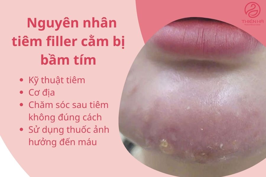 Nguyên nhân tiêm filler cằm bị bầm tím