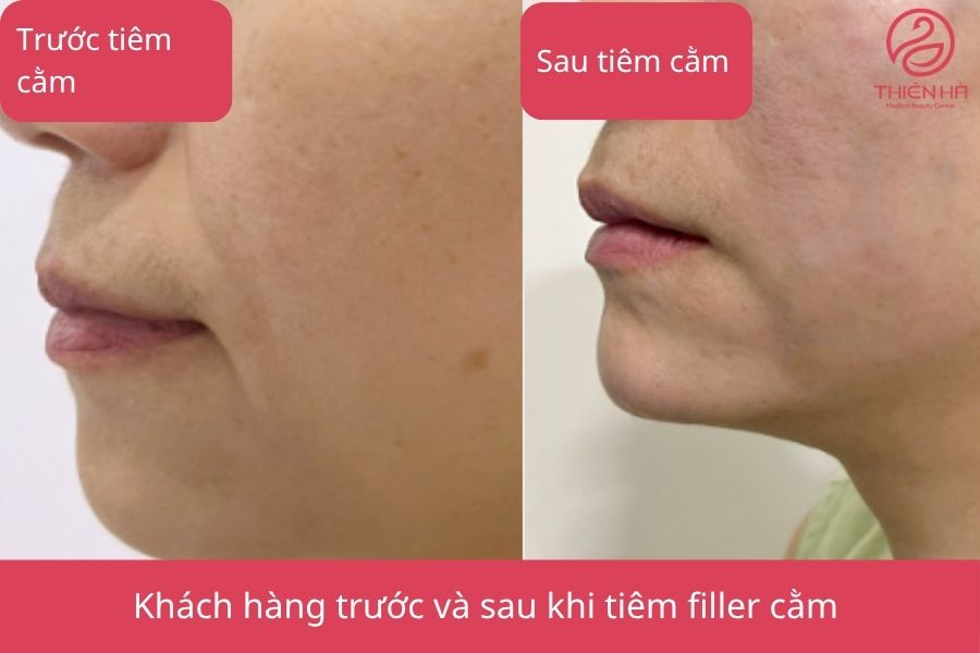 Hình ảnh minh họa trước và sau khi tiêm filler cằm