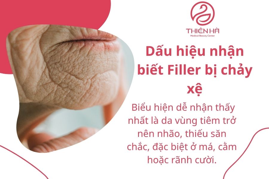 Dấu hiệu nhận biết Filler bị chảy xệ