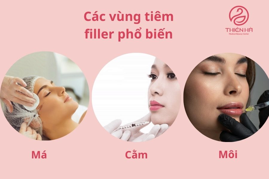 Các vùng tiêm filler phổ biến