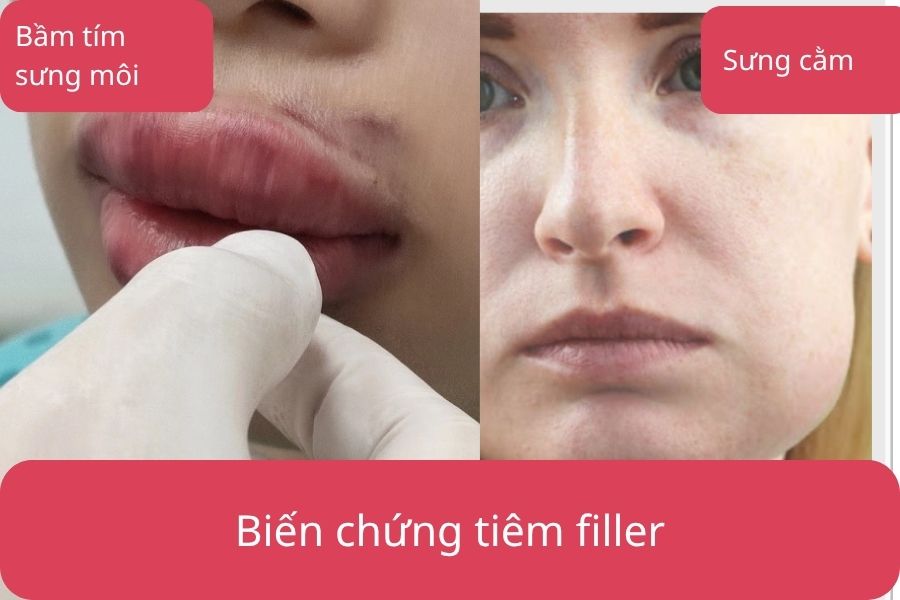 Biến chứng tiêm filler