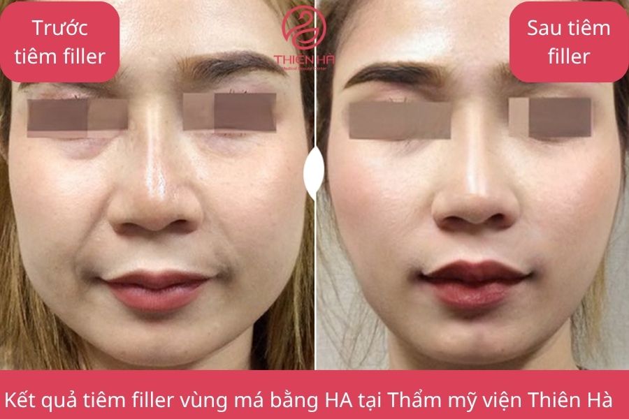 Hình ảnh minh họa trước và sau khi tiêm filler