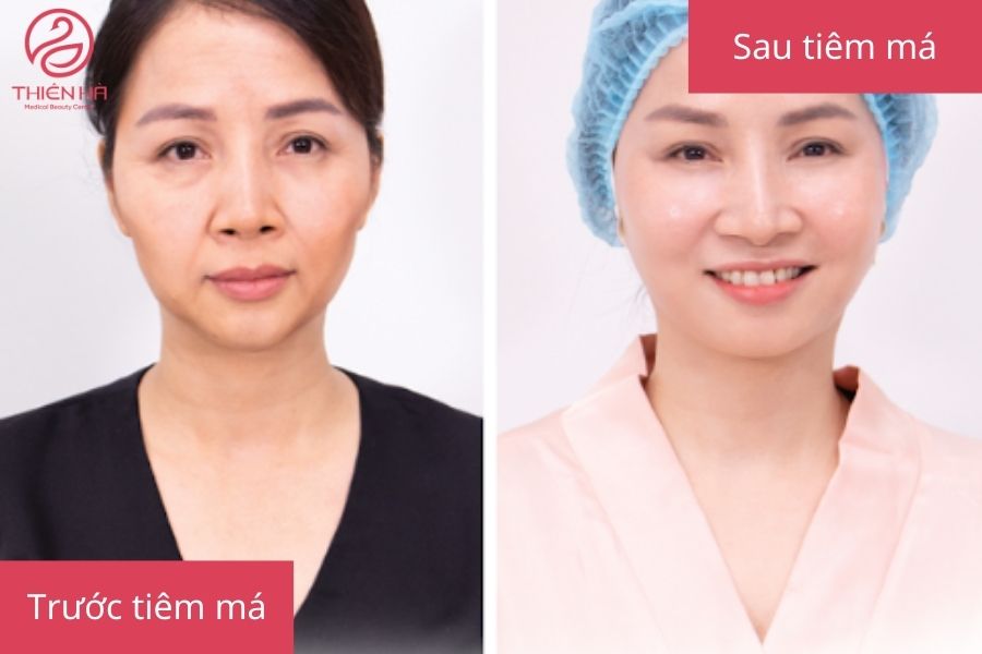 So sánh trước và sau khi tiêm filler má, cho thấy sự thay đổi rõ rệt về độ đầy đặn và trẻ trung của khuôn mặt