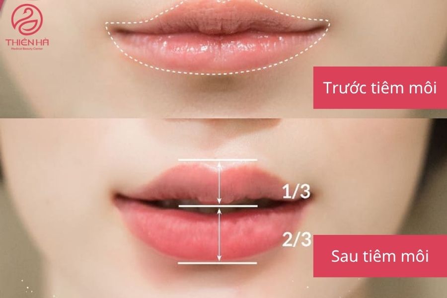 Sự khác biệt rõ rệt sau khi tiêm filler môi