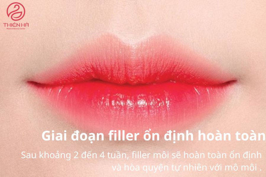 Môi căng mọng, quyến rũ sau khi tiêm filler.