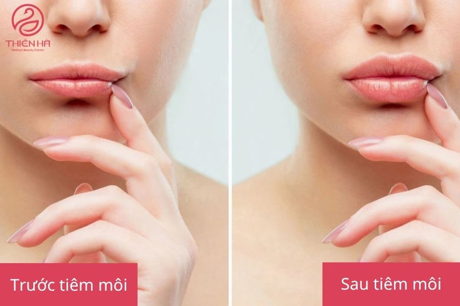 Hình ảnh khách hàng trước và sau khi tiêm filler
