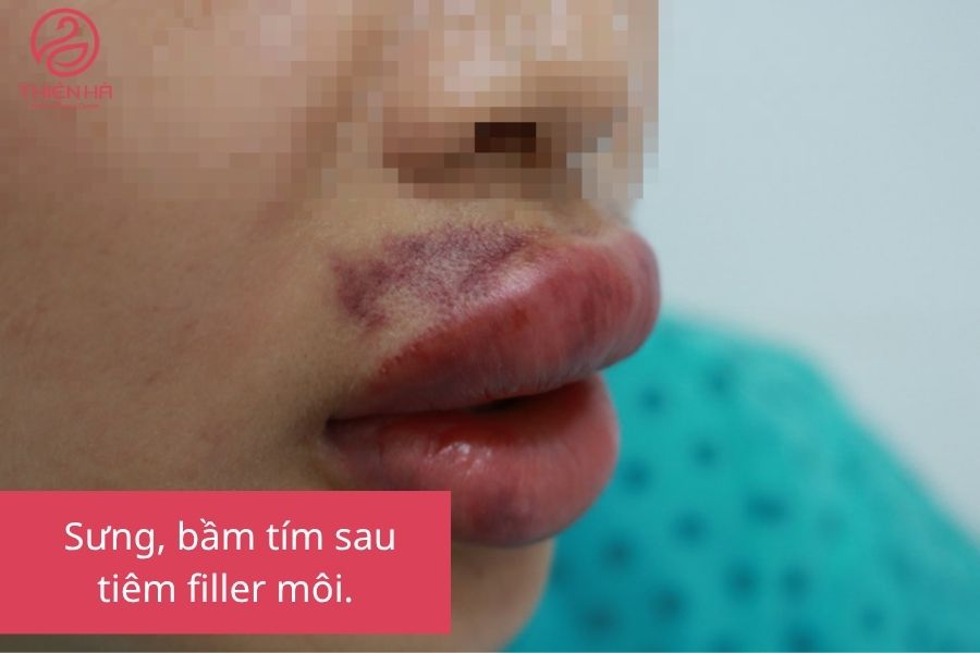 Biến chứng tiêm filler môi cần lưu ý