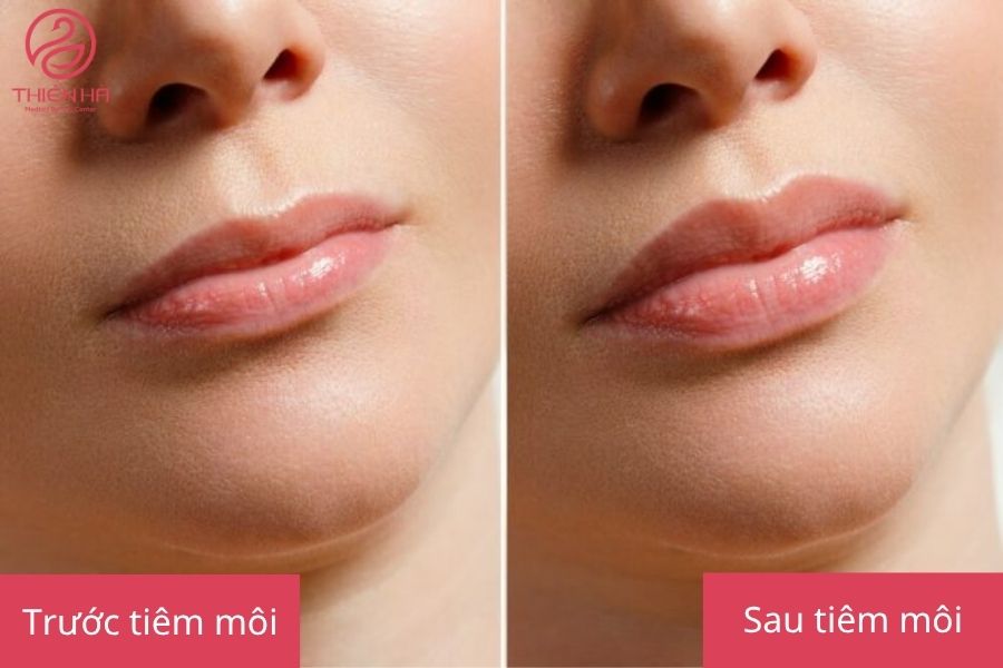 So sánh trước và sau khi tiêm filler