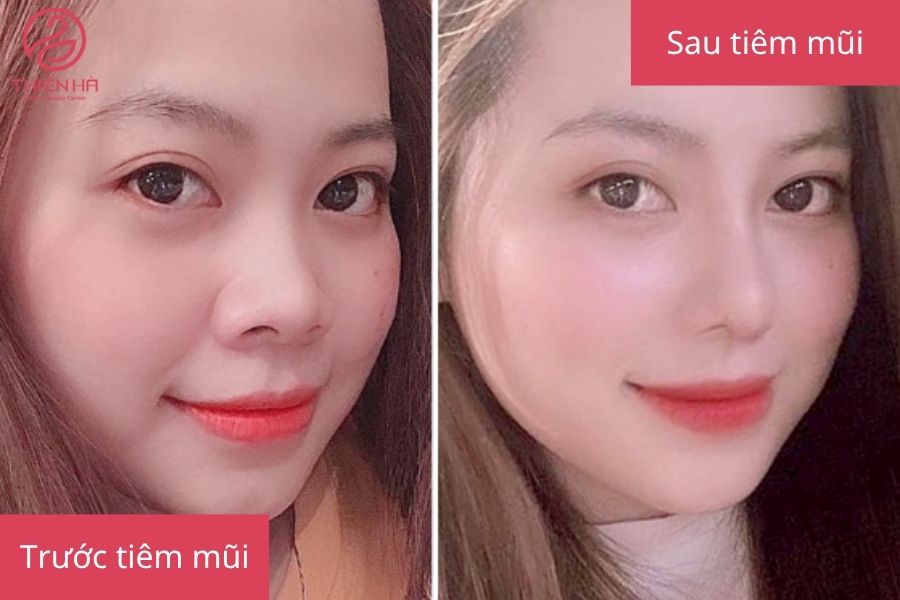 Hình ảnh khách hàng trước và sau khi tiêm filler mũi