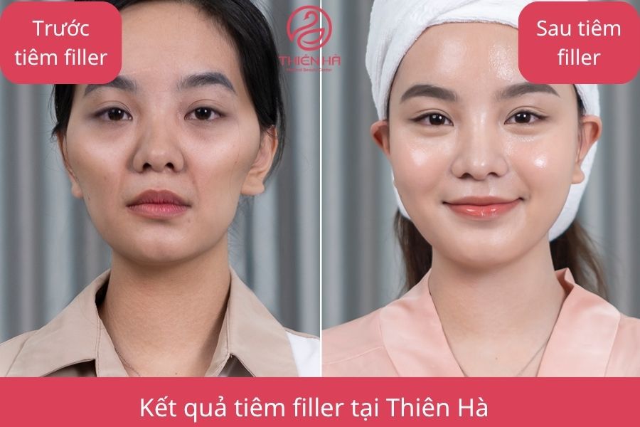 Kết quả tiêm filler tại Thiên Hà