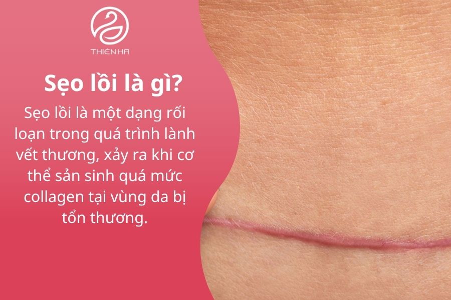 Sẹo lồi là gì?