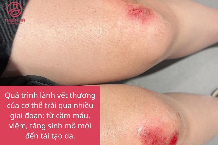 Vết thương bị ngã 
