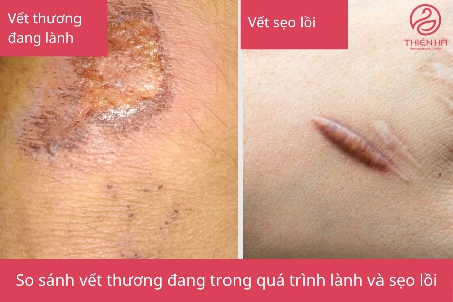 Hình ảnh so sánh vết thương đang trong quá trình lành và sẹo lồi, giúp người đọc dễ dàng phân biệt