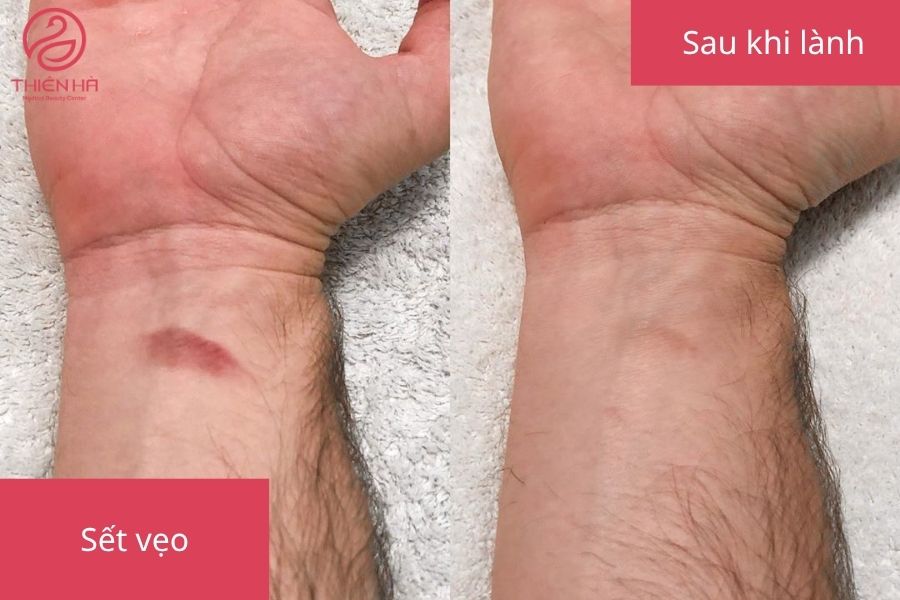 Vết sẹo sau khi đã lành 