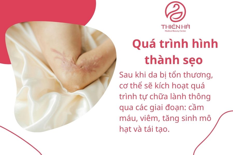 Quá trình hình thành sẹo